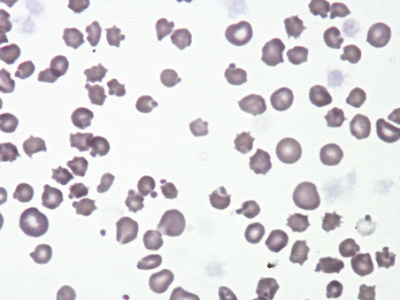 Corpos de Heinz e anemia por dano oxidativo.
